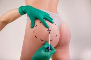 Alogenosis iatrogénica por procedimientos con bioplimeros