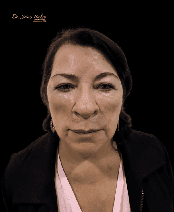 Biopolímeros en el Rostro