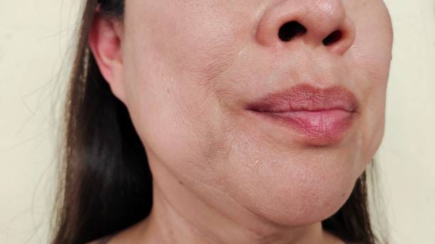 Procedimientos seguros para remover o quitar biopolímeros en el rostro