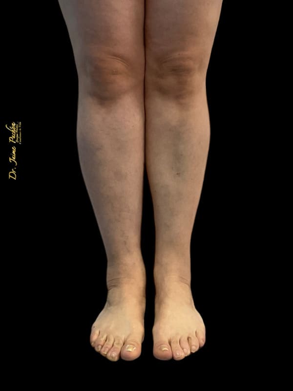 extraccion de biopolimeros en piernas