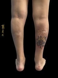 biopolimero en piernas